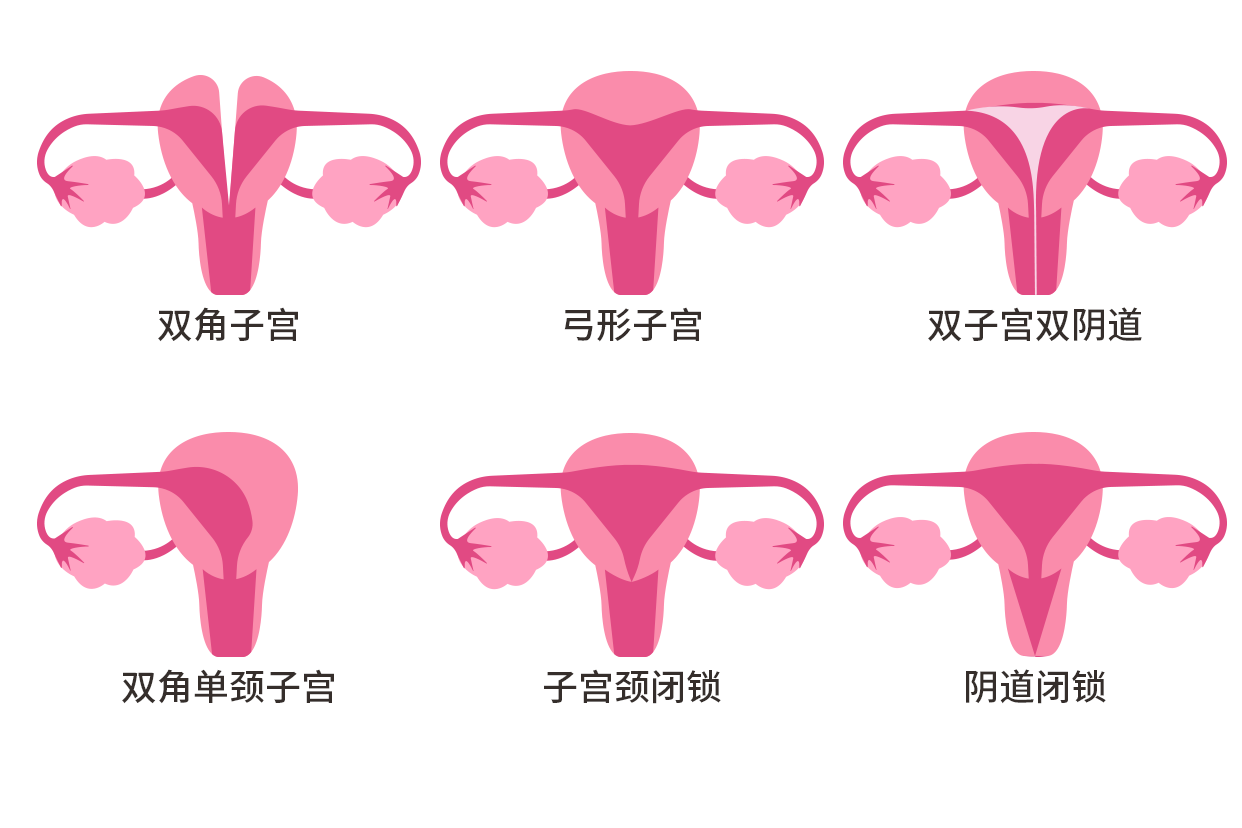 残角子宫示意图