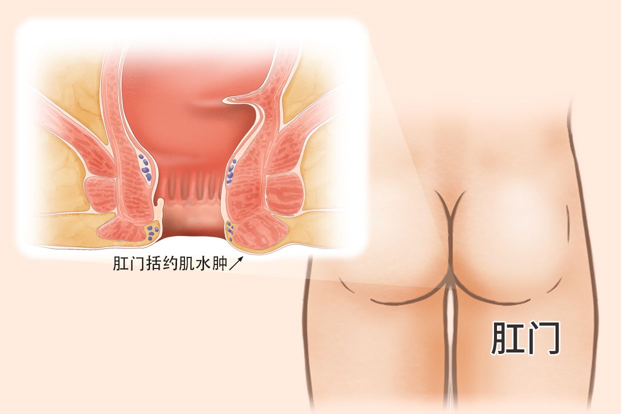 肛门括约肌水肿图片