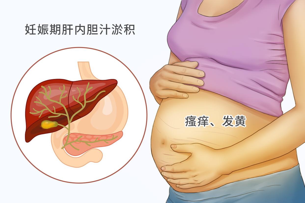 孕妇胆淤和湿疹的图片