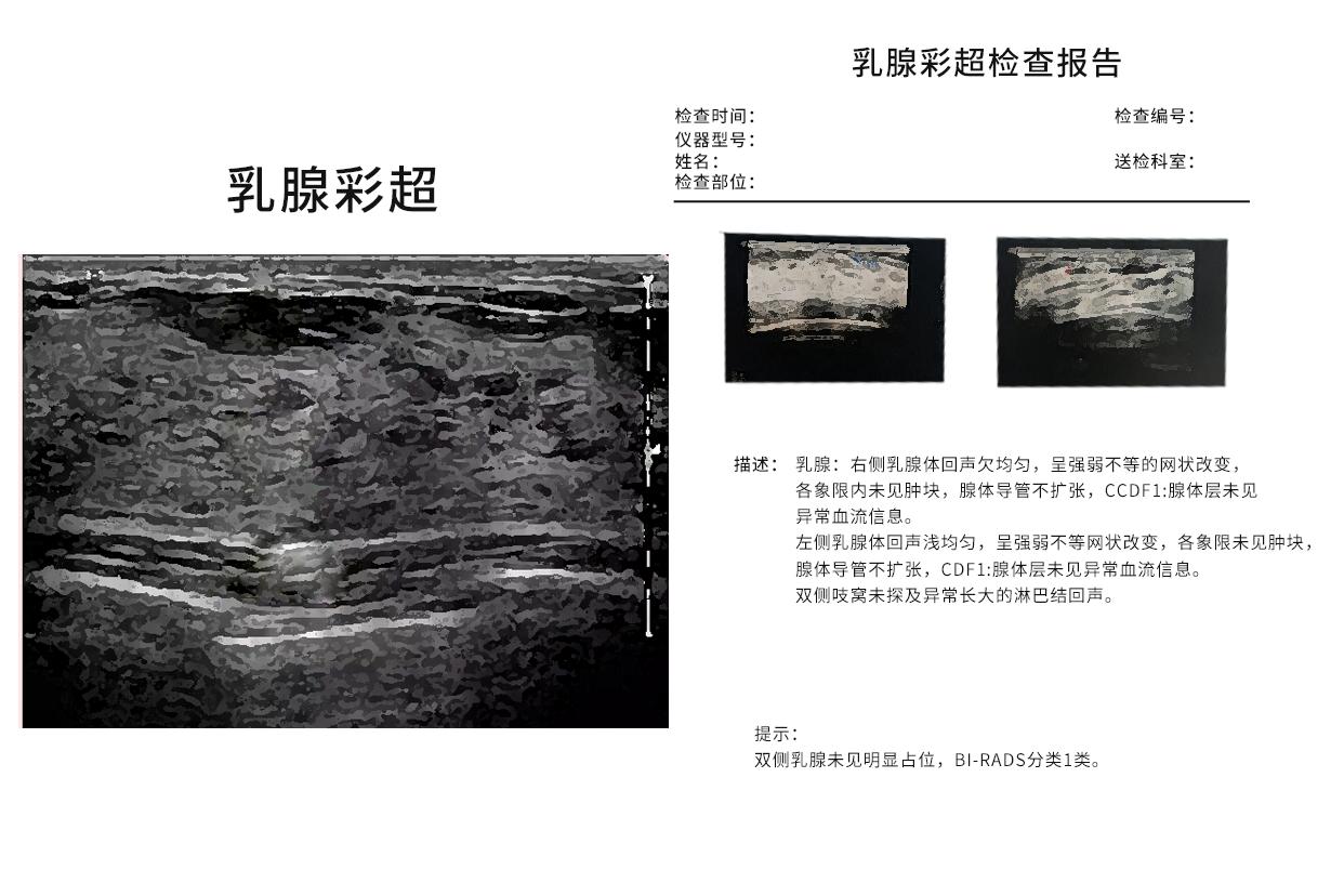 乳腺彩超报告看图片还是看结果