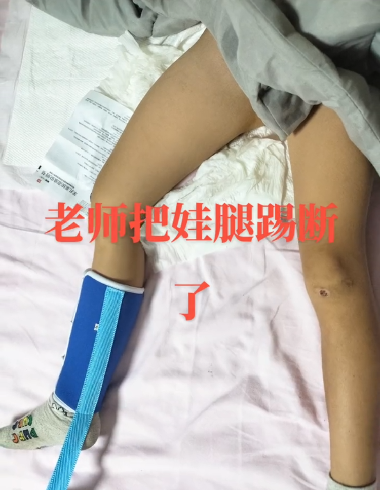 学生因没按时午休被老师踢断腿骨（学生因没按时午休被老师踢断腿骨怎么办）